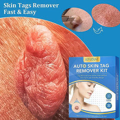 Rubber rings included in skin tag remover kit